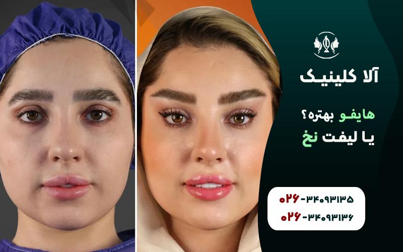 هایفو بهتره یا لیفت با نخ