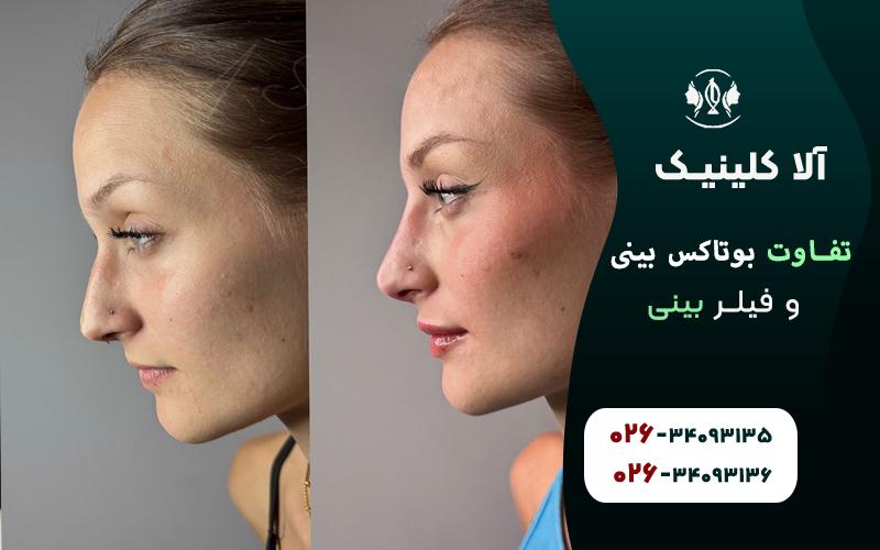 تفاوت بوتاکس بینی و فیلر بینی