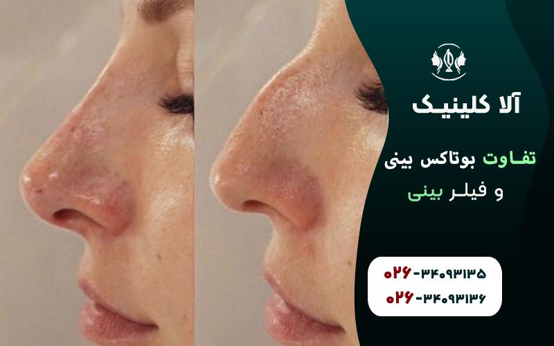 تفاوت بوتاکس بینی و فیلر بینی