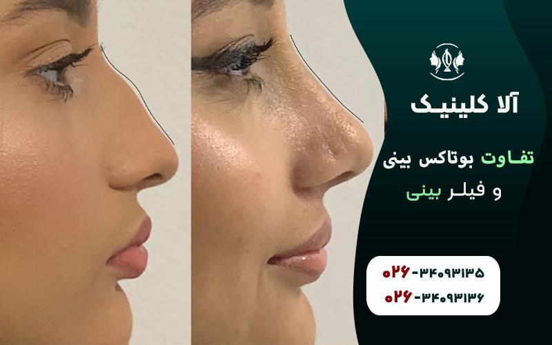 تفاوت بوتاکس بینی و فیلر بینی