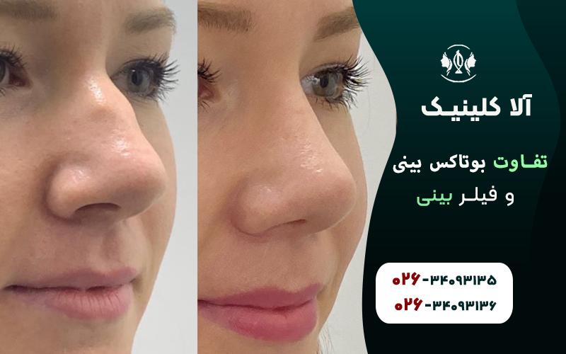 تفاوت بوتاکس بینی و فیلر بینی