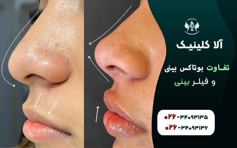 تفاوت بوتاکس بینی و فیلر بینی