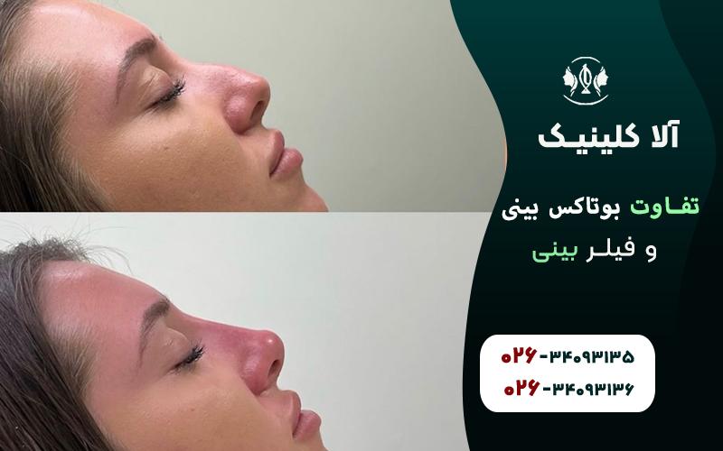 تفاوت بوتاکس بینی و فیلر بینی
