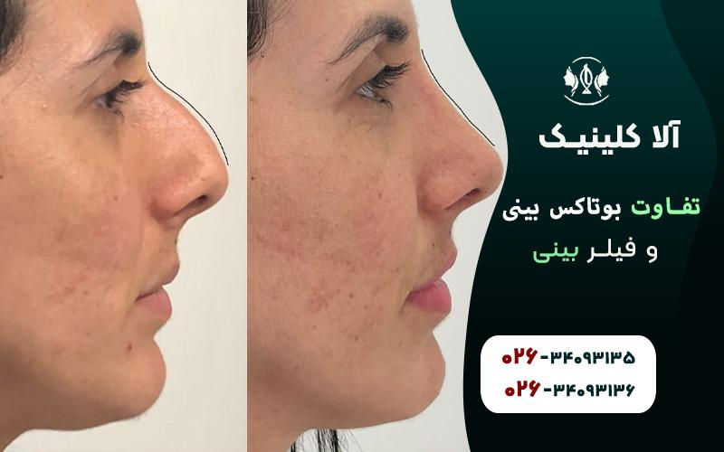 تفاوت بوتاکس بینی و فیلر بینی