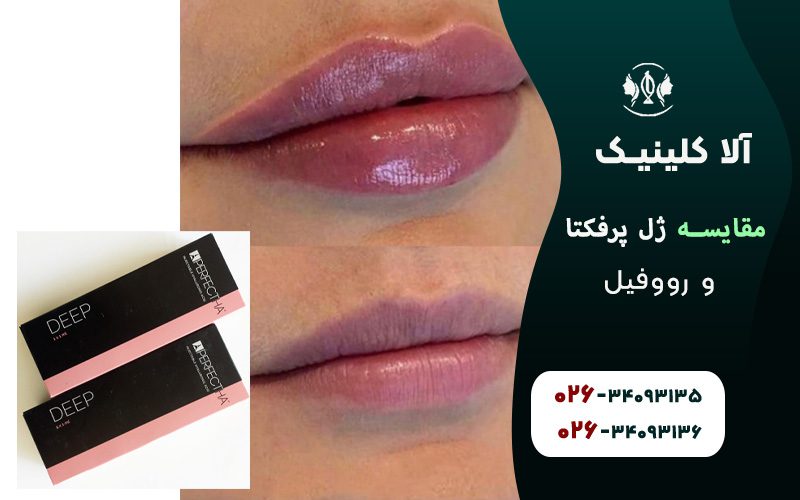 مقایسه ژل پرفکتا و رووفیل
