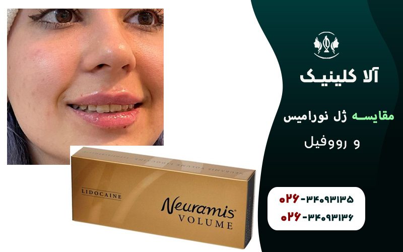 ژل نورامیس