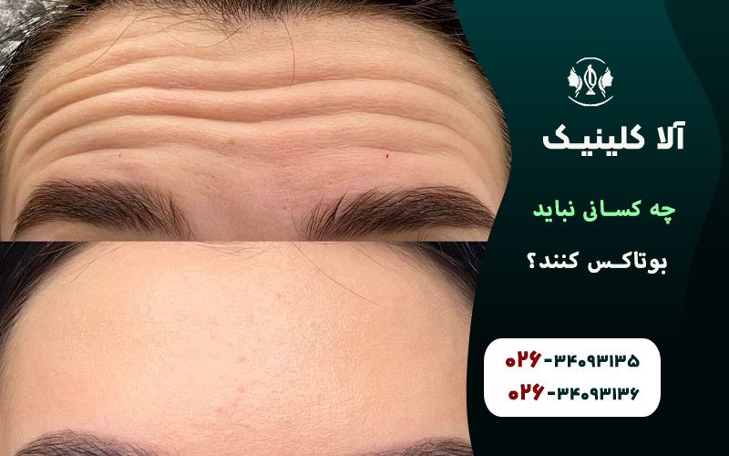 چه کسانی نباید بوتاکس کنند