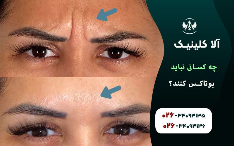 چه کسانی نباید بوتاکس تزریق کنند