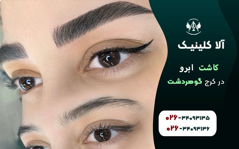 کاشت ابروی طبیعی در کرج