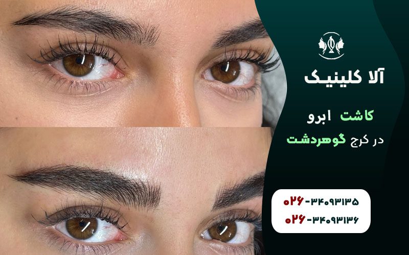 کاشت ابرو در کرج